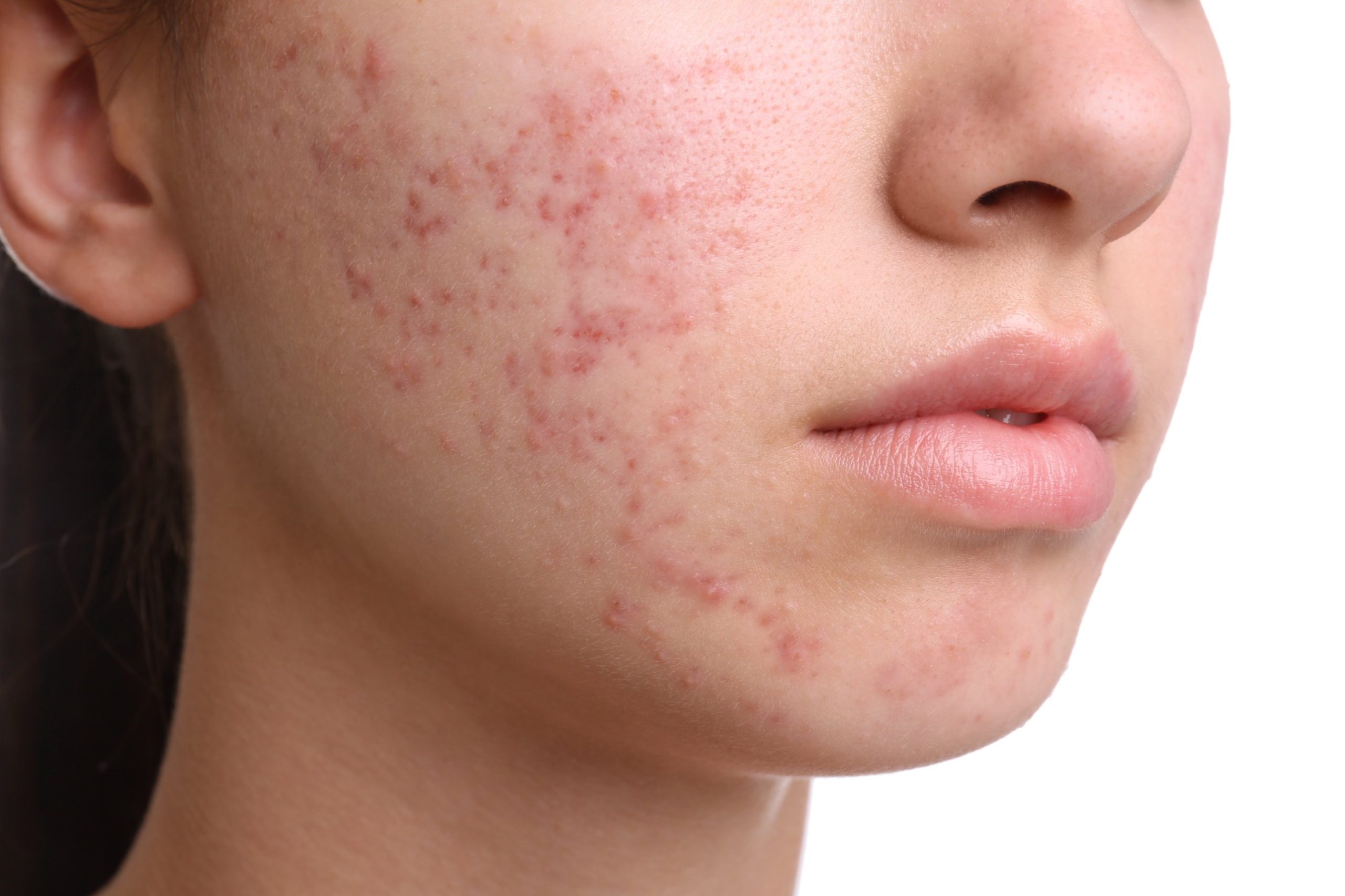 Acne breakouts and redness on the cheek and jawline