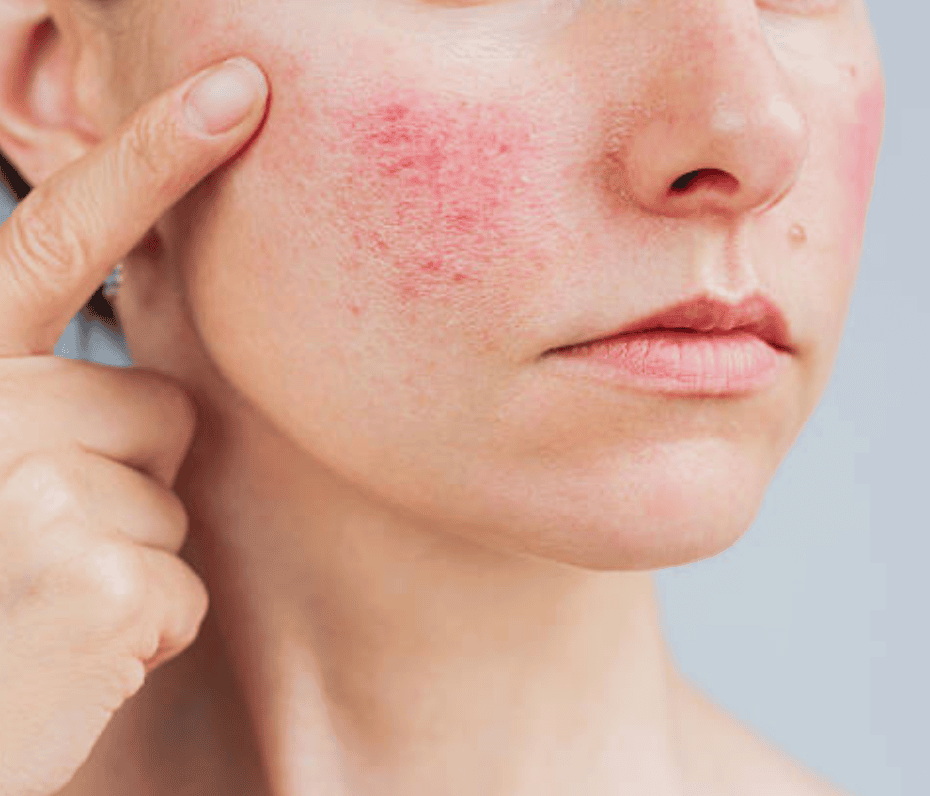 Redness and visible flushing on the cheek, typical of rosacea